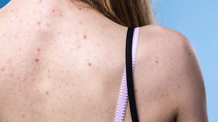 No More Hiding: Expert Tips and Tricks to Improve Back Acne and Reclaim Your Skin’s Natural Glow